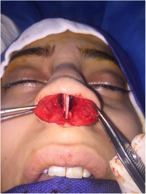 The caudal extension graft was placed between the two parts of the caudal septum in the interlaced cartilage modification. The caudal septum was divided along the site of previous angulation.