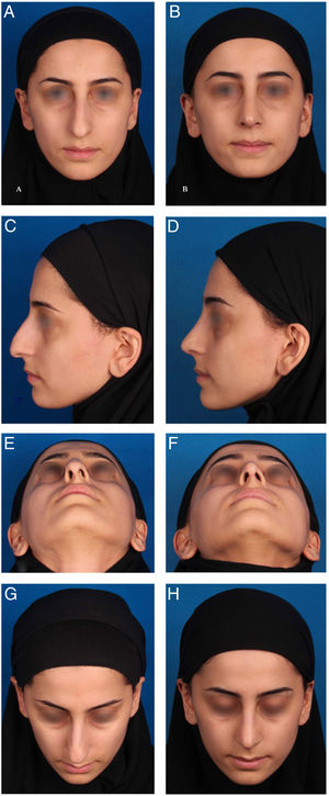 (A, C, E, G) Preoperative and (B, D, F, H) 11 month postoperative views of a 25 year-old woman who underwent cosmetic rhinoplasty with Interlaced cartilages technique. The main problem was tension nose with sever deviation specially in basal view. In this case the bony and cartilaginous hump removal, bilateral auto spreader flaps, medial-transvers and lateral osteotomy and suture technique tip plasty was also performed.