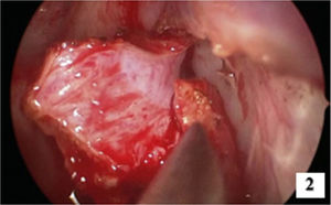 Image of resection with posterior septum margins showing healthy mucosa in this region.