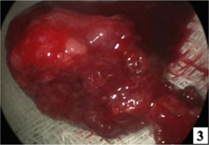 Image showing a pedunculated lesion removed in its entirety with macroscopically healthy margins.