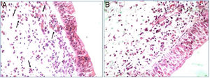 Hematoxylin-eosin stained nasal polypoid tissue. Eosinophilic infiltration, indicated by arrows, predominant in eosinophilic CRSwNP patients (A). Inflammatory infiltrate without eosinophilic predominant in patients with non-eosinophilic CRSwNP (B) (400×).