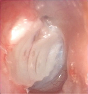 Postoperative first year appearance of the perichondrium-preserved palisade island graft.