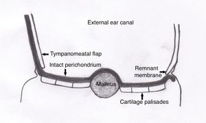 Graft placed with the underlay technique according to the tympanomeatal flap, fibrous anulus and membrane remnant, and the overlay technique according to the malleus. The intact perichondrium that keeps the palisades together faces the external ear canal.