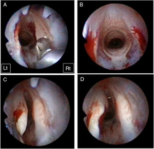 Surgical procedure. Bilateral vocal fold injury was created using microforceps (A). After confirmation of the bilateral consistent injury (B), a volume of 100μL gelatin hydrogel microspheres without bFGF or gelatin hydrogel microspheres with bFGF was injected into the right or left injured vocal folds (C). Vocal fold bulging was observed during all injections (D). Rt and Lt indicate right side and left side, respectively.