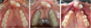 (a) Pretreatment maxillary occlusal view showing the upper arch collapse in bilateral cleft lip palate patient, (b) Bonded Hyrax assembly at the initiation of RME in the same patient and (c) Maxillary occlusal view after completion of RME.