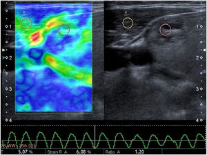 Image of a 38 year-old woman from a dual screen US elastogram. The nodule exhibits a small degree of stiffness with a mixed color of mostly green, a little blue areas consistent with a score of 2. The strain ratio was 1.20. These results indicated a benign form of the disease, and histopathology confirmed a benign nodule.