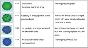 Elasticity Score (ES) of thyroid nodules and its corresponding elastographic pattern proposed be Asteria et al.14