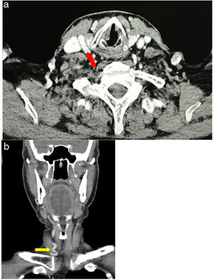 Common carotid artery (CCA) showing a tortuous path in the cervical Computed Tomography, with contrast. (a) Axial section at the larynx glottic level, showing the infrahyoid carotid space, which contains the CCA (red arrow), the internal jugular vein and the vagus nerve (not visible). (b) Coronal section showing the CCA tortuous path (yellow arrow), above its origin in the right brachiocephalic trunk.