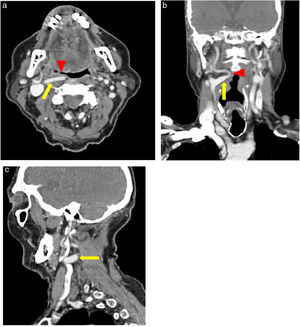 Internal carotid artery showing an aberrant path on the cervical CT scan, with contrast. (a) Axial section showing a variation in the trajectory of the internal carotid artery (ICA) in the parapharyngeal space (yellow arrow), which is medialized and bulging the right posterolateral wall of the oropharynx (red arrowhead). (b) Coronal section showing the right ICA with an aberrant path, with medial “kinking” and serpiginous aspect (yellow arrow) associated with pharyngeal bulging (red arrowhead). (c) Sagittal section showing ICA kinking (yellow arrow).
