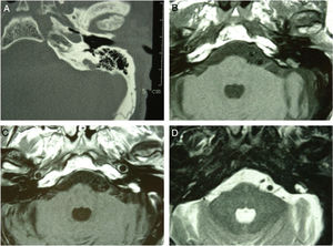 High resolution CT scan of the temporal bone revealed a retrolabyrinthine bone erosion in the region of the left endolymphatic sac, with irregular margins and a “moth-eaten pattern” (A). The mass had an isointense signal on MRI T1-weighted images (B), showed a marked contrast enhancement (C), a hyperintense heterogeneous signal on T2-WI (D).