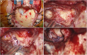 Left retro-auricular transmastoid approach with preservation of the posterior meatal wall, and skeletonization the sigmoid sinus (A); skeletonization of the posterior semicircular canal and removal of the retrofacial cells in order to expose the region of the Endolymphatic Sac (ELS) (B); a retrolabyrinthine bone of red appearance was highlighted by drilling below the Donaldson’s line. It looked infiltrated and eroded by a reddish vascularizated mass enveloping the ELS (C); the ELS with adjacent posterior fossa dura were removed because involved in the lesion (D).