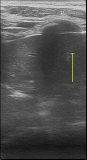 False positive malignant nodules by ultrasound. 53 years woman with non-malignant thyroid tumor diagnosed by tumor histological data. Transverse ultrasound image of the right thyroid lobe. Arrow indicates diffuse parenchymatous disease.