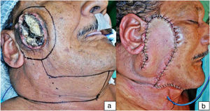 Illustrative case. Case “4″ from Table 1. In the first picture (a), a primary neglected cutaneous squamous cell carcinoma, deeply ulcerated by recent myiasis, and the surgical planning. In the second one (b), the immediate postoperative result.