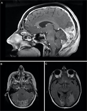 Sagital (A) and axial (B) contrast-enhanced T1-weighted MRI showing thickening and enhancement of the dura suggestive of pachymeningeal carcinomatosis (arrow). Axial (C) T2-FLAIR-weighted MRI showing vasogenic edema in the right occipital lobe and left occipito-temporal region.