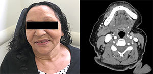Absence of cervical tumorations 72 months after admission. CT scan maintained resolution of left submandibular gland tumor 75 months after remission.
