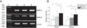 The mRNA expression of MMP-2 and MMP-9 in tumor tissues of different clinical stages obtained from hypopharyngeal carcinoma patients. (A) Representative mRNA expression of MMP-2 and MMP-9 in tumor tissues of different clinical stages. Expression of MMP-2 and MMP-9 was elevated with increasing clinical stage (lane 1, 1 kb DNA ladder; lane 2, Stage I + II patient; lane 3, Stage III patient; lane 4, stage IV patient). (B) Relative intensity of MMP-2 and MMP-9 mRNA expression in tumor tissues of different clinical stages. Advanced stage patients exhibited higher levels of MMP-2 and MMP-9 mRNA expression than early stage patients (*p < 0.05 and **p < 0.01).