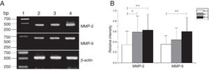 The mRNA expression of MMP-2 and MMP-9 in tumor tissues of different N stages obtained from hypopharyngeal carcinoma patients. (A) Representative mRNA expression of MMP-2 and MMP-9 in tumor tissues of different N stages. Expression of MMP-2 and MMP-9 was enhanced with increasing N stage (lane 1, 1 kb DNA ladder; lane 2, stage N0 patient; lane 3, stage N1 patient; lane 4, stage N2 patient); (B) Relative intensity of MMP-2 and MMP-9 mRNA expression in tumor tissues of different N stages. Lymphatic metastasis patients exhibited higher levels of MMP-2 and MMP-9 mRNA expression than stage N0 patients (*p < 0.05 and **p < 0.01).