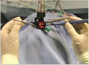 Bivalve laryngoscope in place. The angled fórceps (left hand) and the angled microelectrode (right hand), hands are off the field. Surgical microscope is then used.