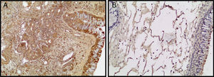 Photomicrographs of LC3 staining within the ITR (A) and NPs (B) tissues is depicted. (Original magnification ×200).