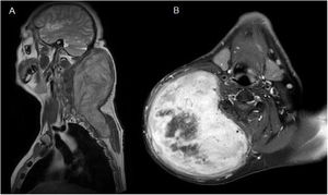 (A) Coronal T1-weighted Magnetic Resonance Imaging (MRI) showed the presence of a subcutaneous mass measuring 13 × 14 × 22 cm in the posterior area of the neck which extended into the posterior thoracic wall. (B) Axial T1-weighted MRI showed significant enhancement of the mass and highlighted a central necrotic area.