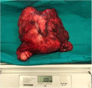 Macroscopic appearance of the mass after complete excision. The mass measured 20 × 22 × 25 cm and weighed 1 kg.