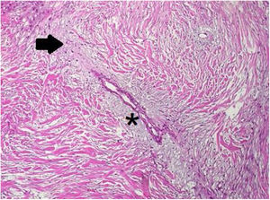 Histological image showing spindle-shaped cells with dull nuclei (arrow) and focally myxoid change (asterisk).