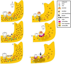 Etiology of osteomyelitis in patients with pycnodysostosis. (A) Osteoclasts release H + and cathepsin K into How ship lacunae during tooth extraction in patients with normal bone density. (B) After bone resorption, osteoblasts are attracted to the site and initiate the process of bone neoformation. (C) Newly formed bone. (D) In the absence of cathepsin K, osteoclasts act inefficiently, leading to acid medium. Patients with osteosclerosis are more susceptible to fractures in response to small traumas because of reduced bone vascularization. (E) The presence of microorganisms, the acid medium and the impairment of bone turnover cause the formation of bone sequestrum. (F) Caries and periodontal disease induce the release of inflammatory mediators and microbial products and associated with impaired osteoclast activity, promote osteomyelitis in patients with pycnodysostosis.
