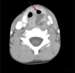 Enhanced CT: left peri-thyroid abscess and gas shadow.