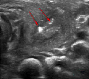 Ultrasound examination: strong echoes of gas scattered in the left thyroid abscess.