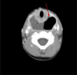 Enhanced CT: Post-pharyngeal abscess and air shadow (Horizontal scan).