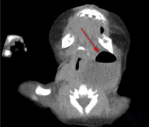 Enhanced CT: Parapharyngeal space abscess and air shadow (Horizontal scan).