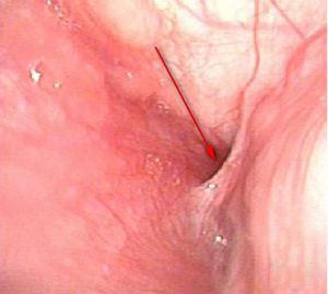 Presence of an internal of left piriform fistula under a self-retaining laryngoscope.
