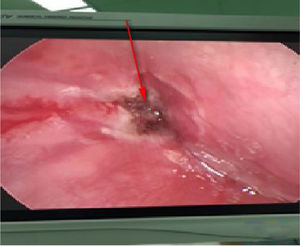 The left piriform sinus fistula after burning under a self-retaining laryngoscope.