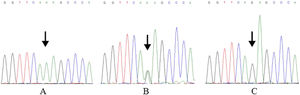 DNA sequencing results of rs7078160. (A) Mutated homozygous genotype AA. (B) Heterozygous genotype AG. (C) Wild homozygous genotype GG.