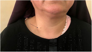 The pulsatile mass in the lower part of the neck, an arrow is referring to the most prominent part of the mass.