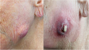 Anterior left parotid and upper jaw swelling (left image) and cutaneous ulcer with purulent drainage coming from the left accessory parotid gland (right image).