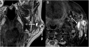 Coronal T2-weighted image (A) and Axial STIR image (B) show a well-defined ovoid low signal-intensity lesion within the accessory parotid lobe, consistent with a sialolith (β), and severe dilation of Stensen’s duct (α).