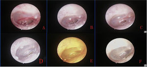 The healing process of large perforation after topical application of ofloxacin otic solution: 1st after perforation (A), and 4 days (B), 7 days after treatment (C), and 2 weeks (D), 3 weeks (E) and 7 weeks after treatment (F).