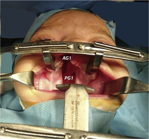 Measurement of alveolar gap (AG) and palatal gap (PG) at first surgery.