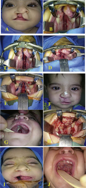 Six-month-old female presented with complete right cleft lip and palate (A) preoperatively, (B) through (D) vomer flap marking and insetting, (E) and (F) five days after surgery, (G) through (I) second stage complete palatal repair after 3 months, (J) five days after the second surgery.