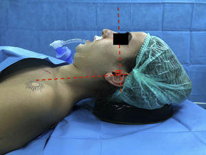 The initial head and neck (neutral) positions of all patients while they were in supine position. Gel pillow (height: 3cm) was placed under patients’ heads and the two imaginary lines (1) between external ear canal to the top of the shoulder and (2) the external ear canal to the superior orbital margin were adjusted to be vertical.