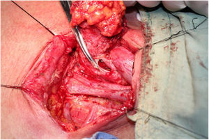 The gastro-esophageal anastomotic site was reached and opened.