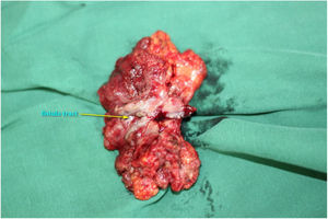 The granulation tissue embedding the fistula tract with part of the gastroesophageal stump was removed enbloc.