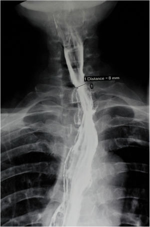 Barium swallowing X-ray 10 months later demonstrated a smooth alimentary tract without any anastomotic stricture.