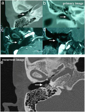 The temporal bone CT and MRI of Case 3. Images A, B, C, D showed the lesion was located in the meso- and hypotympanum with ossicular chain encasement on temporal bone CT (A, axial; D, coronal), and moderately enhance with gadolinium administration on MRI (C, axial; D, cronal). Image e showed tumor recurrence on high resolution temporal bone CT (E, axial), it demonstrated an isointensity mass located in the tympanum without bone erosion.