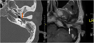 The temporal bone CT and MRI of Case 6. Temporal bone high resolution CT and temporal bone MRI with enhancement shows the lesion filled in the external auditory canal and tympanum with ossicular chain encasement and partially absorption (A, CT axial), and moderately enhanced with gadolinium administration on temporal bone MRI (B, MRI axial).