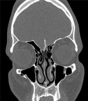 Etmoid roof asymmetry and concha bullosa. Unilateral concha bullosa and ethmoid roof asymmetry are evident. Coronal section the paranasal sinus CT image is the section where the infraorbital nerve was first seen, and all measurements were taken from this section.