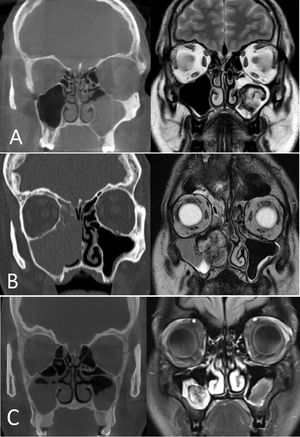 (A) Patient 1, coronal CT slice without injection: left maxillary sinus fullness with thickening of surrounding bone. Coronal MRI slice T2-weighted: Heterogeneous tumor in left maxillary sinus with liquid retention. (B) Patient 2, coronal CT slice without injection: right maxillary sinus fullness with intersinusonasal wall demineralization from tumor compression, extending to the surrounding ethmoid cells and nasal fossa. Coronal MRI slice T2-weighted: right maxillary sinus tumor in antra with liquid retention. (C) Patient 3, coronal CT slice without injection: partial maxillary sinuses fullness predominant on the right with intact surrounding bone. Coronal MRI slice T2-weighted: right antral maxillary sinus heterogenous tumor. Thickened mucosa in the left maxillary sinus.