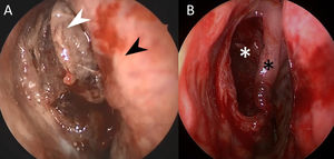 Patient 2 (A), endoscopic view of the right nasal fossa before resection: white arrow: tumor. Black arrow: nasal septum. (B) Same view after total endoscopic resection: one must notice the integrity of the mucosa and bone. White asterisk: posterior wall of right maxillary sinus. Black asterisk: right middle turbinate.