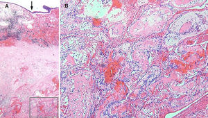 Patient 2 (A), histological analysis showing a respiratory mucosa overhanging an old, organized hemorrhage (framing) with evidence of active resorption (siderophages). The arrow indicates the surface epithelium. (B) Higher magnification showing a non-atypical endothelial proliferation organized in the form of a labyrinthine network and papillary buds. H&E coloring. Original magnification: (A) 20×; (B) 100×.